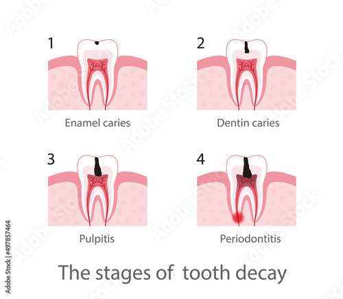 The stages of tooth decay, vector illustration