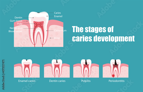 The stages of tooth decay, vector illustration