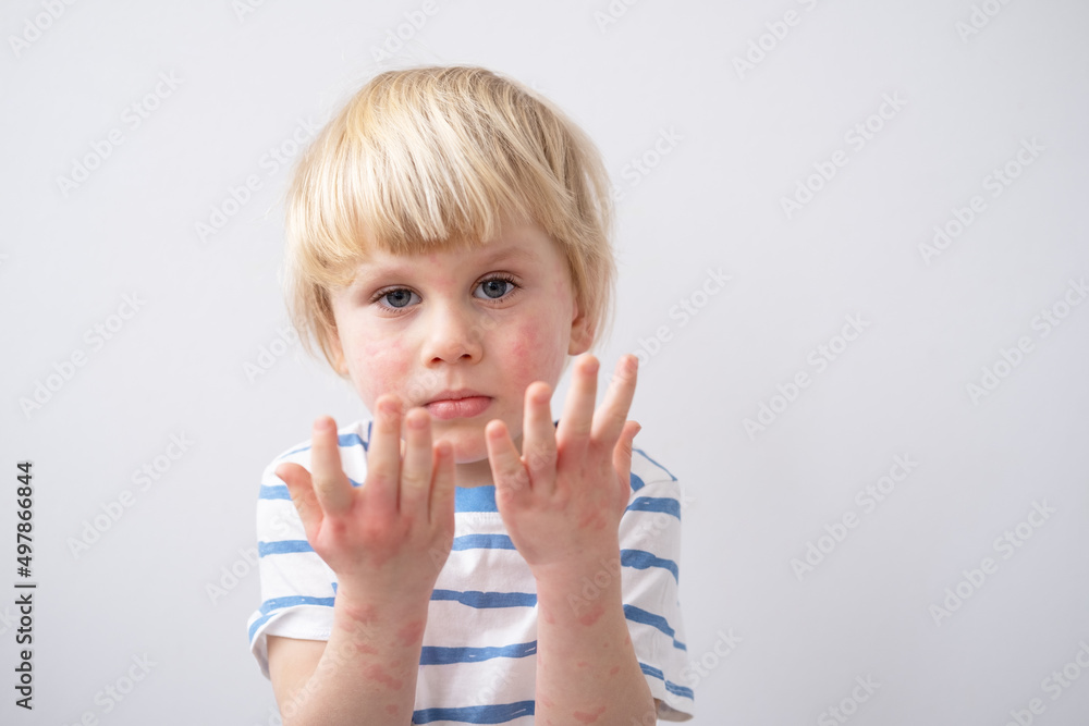 little boy with allergic rash or eczema on face and hands. severe