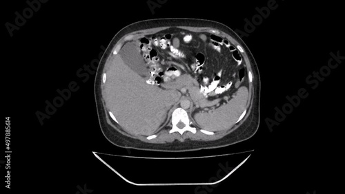 axial CT Scan Video of large Uterine leiomyomas, also known as uterine fibroids
 photo