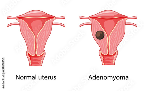Adenomyoma Adenomyosis Human anatomy Female reproductive Sick and normal system organs. Location scheme uterus icon. Vector medical Cross section disease illustration isolated on white background