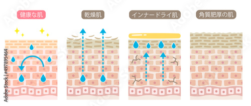 健康な肌とダメージ肌の断面図 