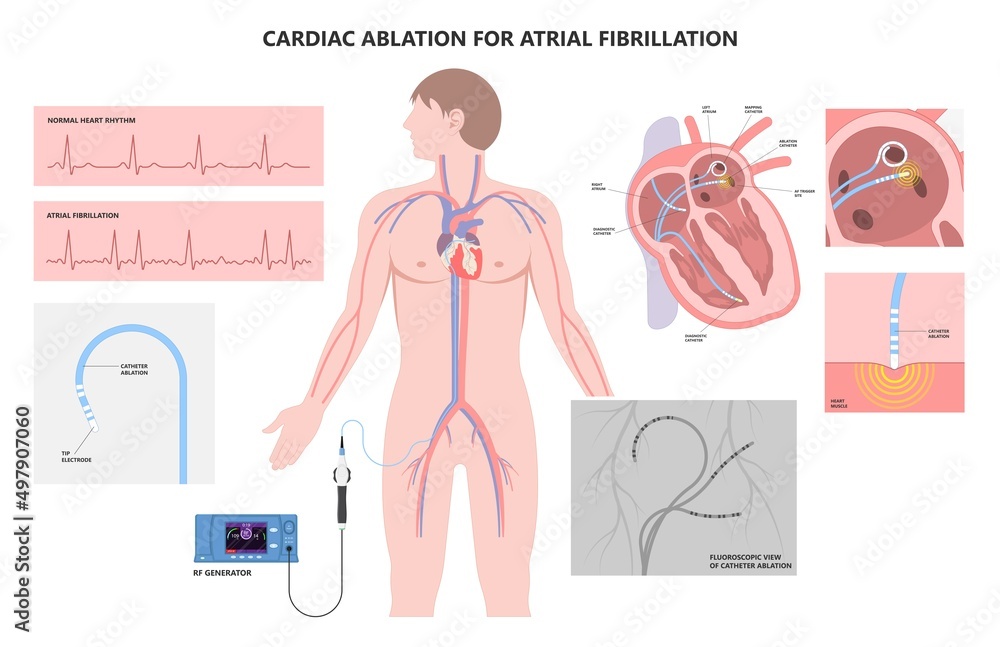 Cardiac catheter ablation treatment Atrial fibrillation rhythm problem  minimally invasive procedure attack cath lab treat Coronary x-ray Radio  frequency Sinus Ventricular SVT ECG ICD Radiofrequency AV Stock Vector |  Adobe Stock