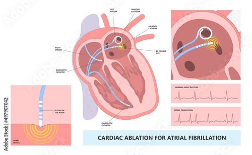 minimally invasive procedure attack Cardiac catheter ablation Atrial fibrillation rhythm problem cath lab treat treatment Coronary x-ray Radio frequency Sinus Ventricular SVT ECG ICD Radiofrequency AV