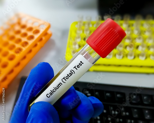 Blood sample for calcium (total) test. photo