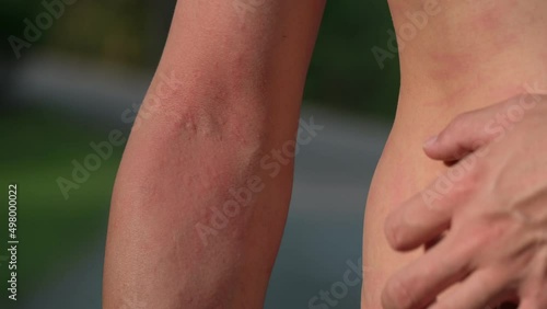 man suffering from itching on arm skin body and scratching an itchy place. Allergic reaction to allergic a caterpillar sting or insect bites, dermatitis, food, drugs. Health care concept. photo