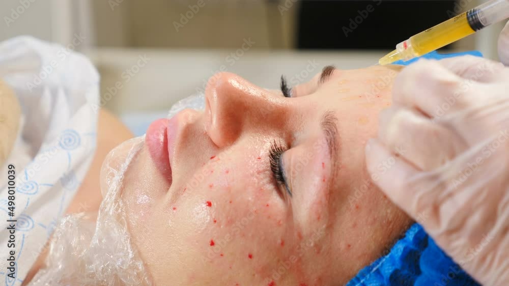 Modern beauty invasive procedure on face. Plasmolifting injections. Side view. Cosmetologist injecting stem cells to female patient. Dermatology anti-aging wrinkle treatment in clinic. Salon Modern beauty invasive procedure on face. Plasmolifting injections. Side view. Cosmetologist injecting stem cells to female patient. Dermatology anti-aging wrinkle treatment in clinic. Salon