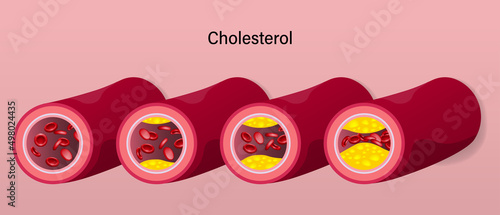 stage of cholesterol accumulation in blood vessels. Atherosclerosis. Clogged arteries caused by cholesterol.