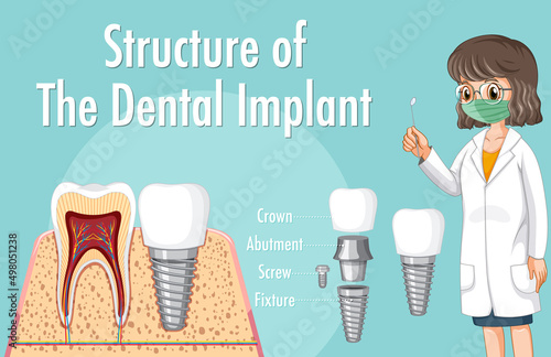 Infographic of human in structure of the dental implant