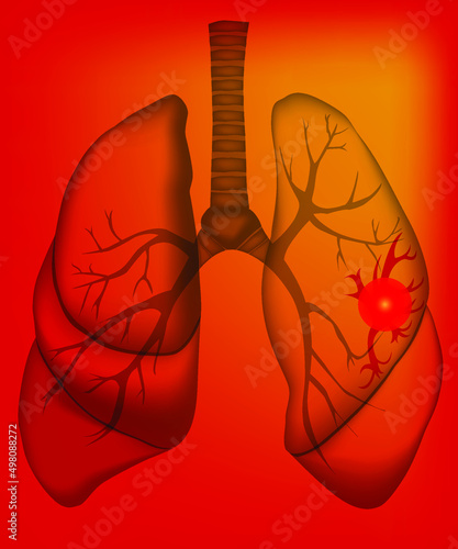 The illustration of sick human lungs with pain and sickness in a left lung. The picture is in the x-ray style. Can be used for medical, advertising and science materials. Vector illustration.