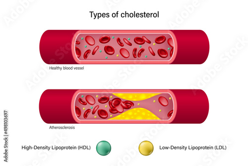 Types of cholesterol. High-Density Lipoprotein (HDL) and Low-Density Lipoprotein (LDL). photo