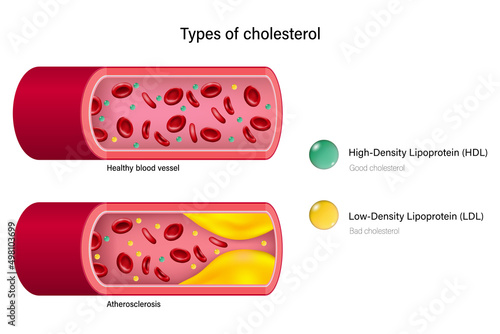 Types of cholesterol. High-Density Lipoprotein (HDL) and Low-Density Lipoprotein (LDL).