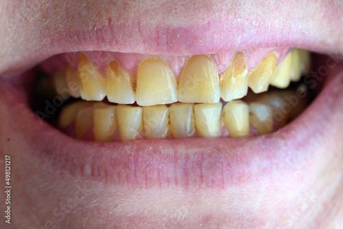 a woman smiles, lips and teeth with plaque and caries, woman's mouth