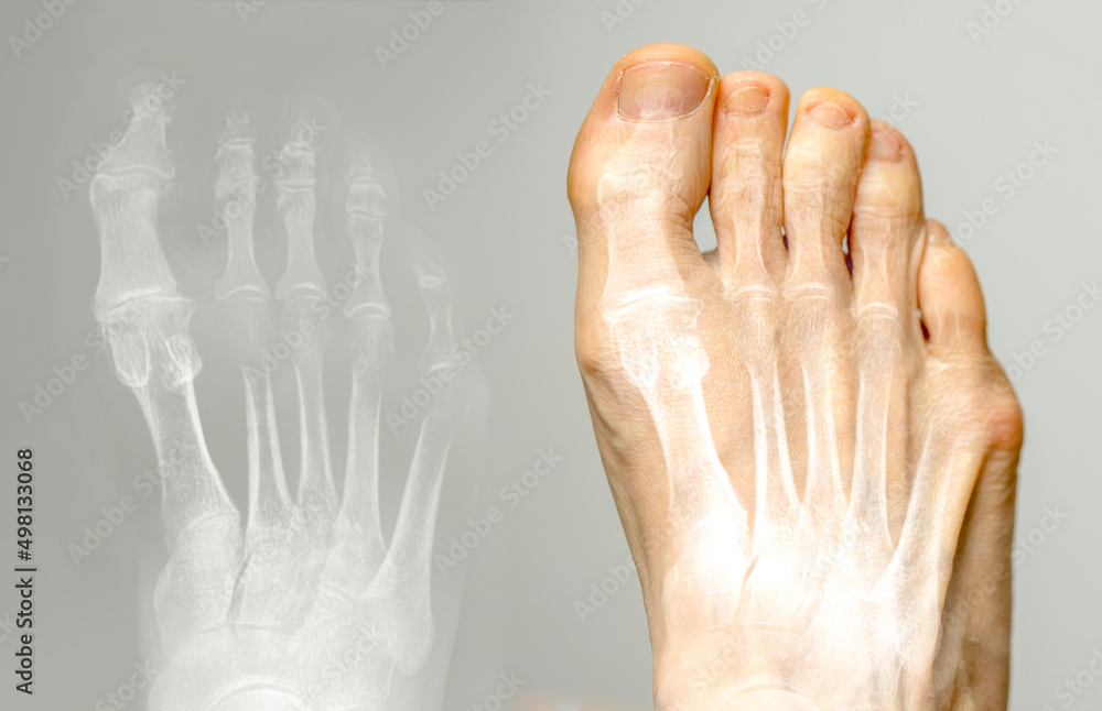 X-ray and the same foot. Hallux varus condition. - obrazy, fototapety, plakaty 