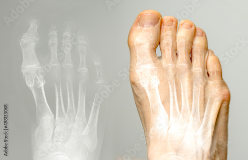 X-ray and the same foot. Hallux varus condition. photo