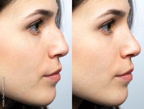 Nose before and after nasal filler surgery photo