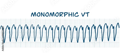 ECG example of monomorphic VT photo