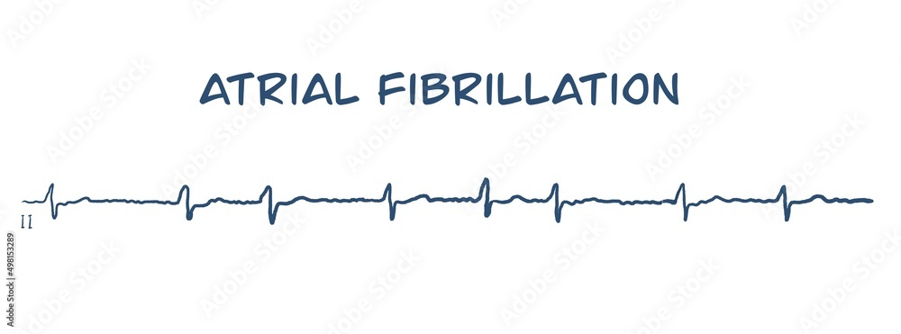 ECG example of atrial fibrillation