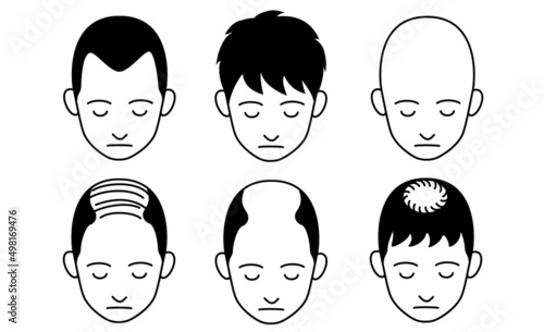 色々な薄毛タイプのイラストのセット
