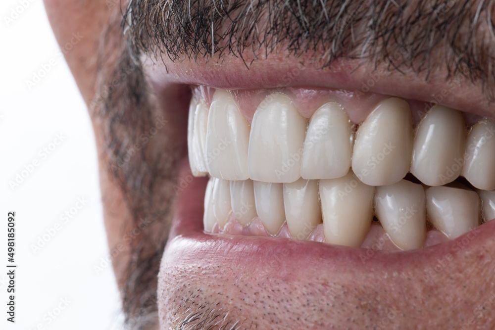 Obraz premium dental macro photography, ceramic crowns and veneers