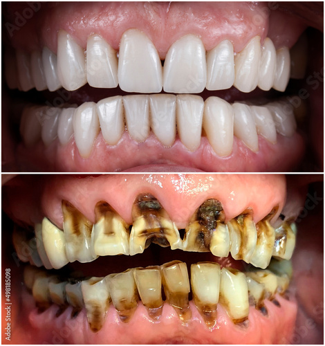 dental macro photography, ceramic crowns and veneers