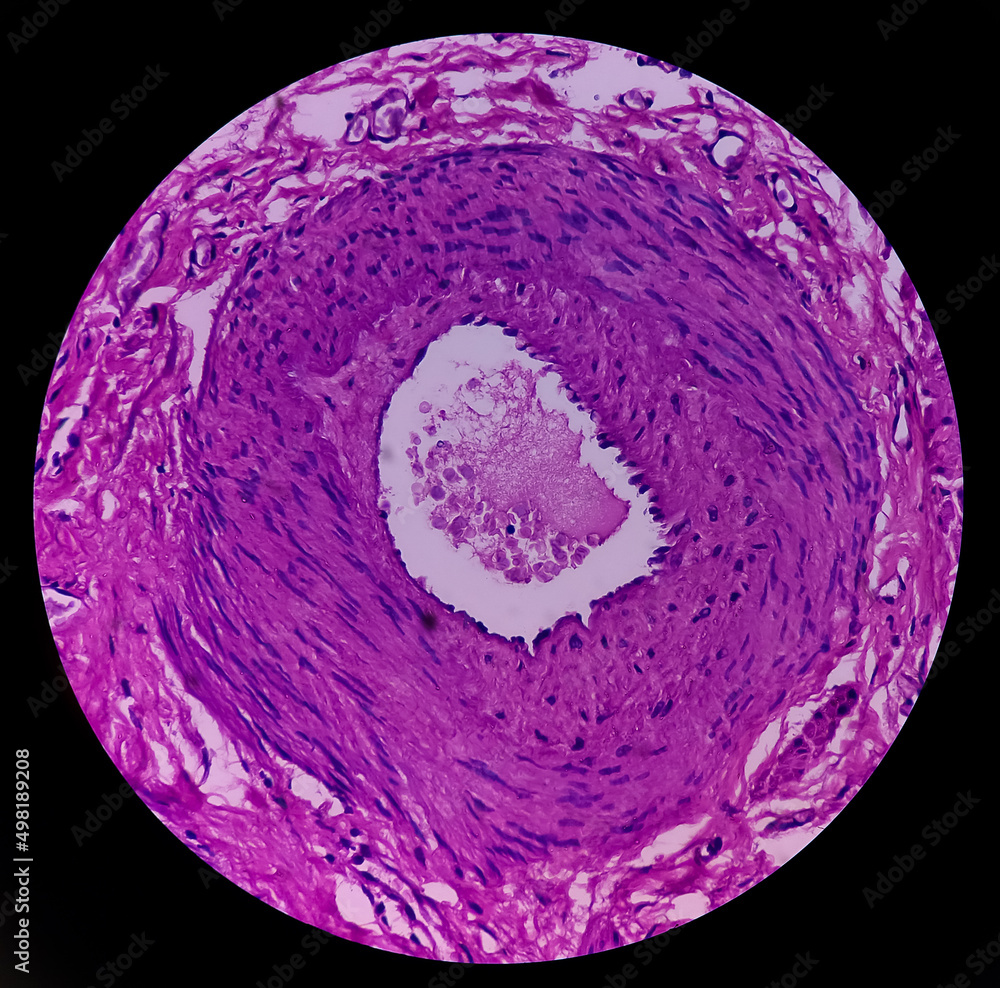Fimbrial cyst(biopsy) show fallopian tube, features of fimbrial cyst