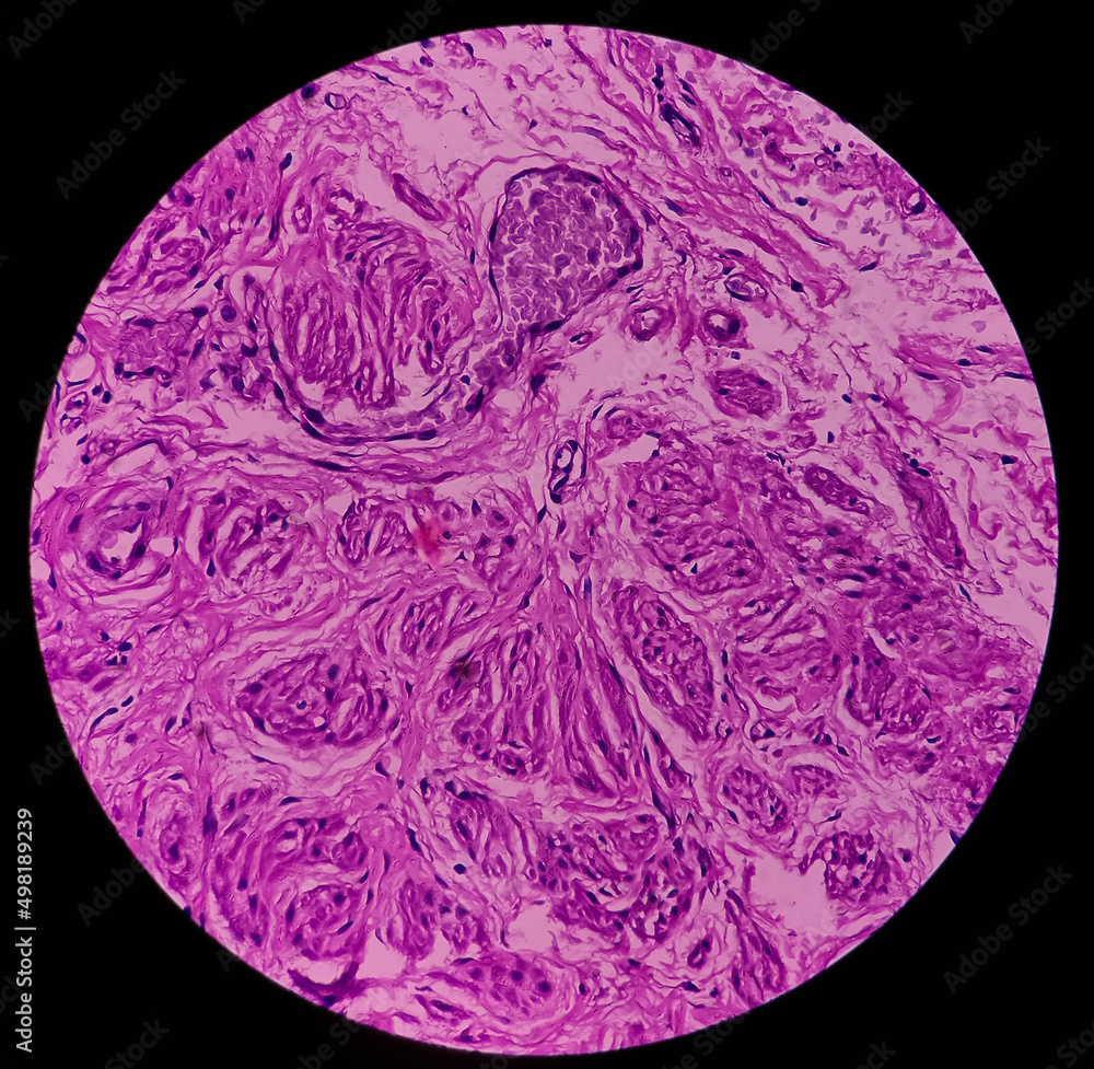Hyalinizing trabecular adenoma: microscopic show thyroid tissue, features of hyalinizing trabecular adenoma, nodular goitre. Hyalinizing trabecular adenoma: microscopic show thyroid tissue, features of hyalinizing trabecular adenoma, nodular goitre.