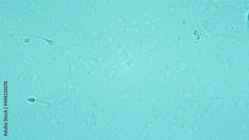 In vitro fertilisation. IVF. Selection of genetic material for the fertilization of the egg. Human spermatozoa under a microscope. 1000X magnification. Programming characteristics of future offspring In vitro fertilisation. IVF. Selection of genetic material for the fertilization of the egg. Human spermatozoa under a microscope. 1000X magnification. Programming characteristics of future offspring