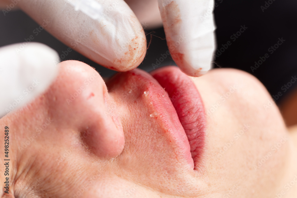 Young lady getting injections for bigger, fuller lips. The woman in the beauty salon. Plastic surgery clinic.
Young lady getting injections for bigger, fuller lips. The woman in the beauty salon. Plastic surgery clinic.