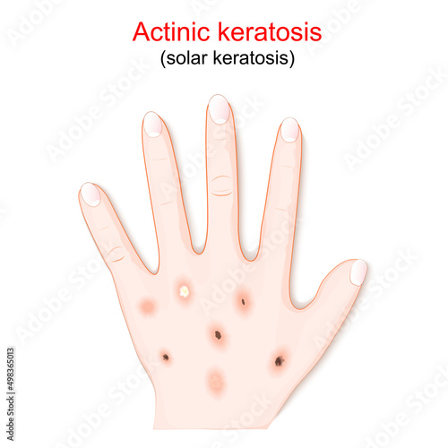 Actinic keratosis. solar keratosis