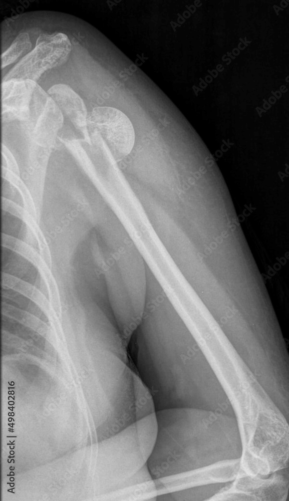 x-ray image of proximal humerus fracture x-ray image of proximal humerus fracture