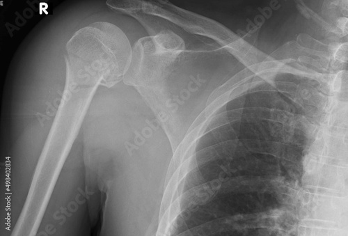x-ray image of proximal  humerus  fracture photo