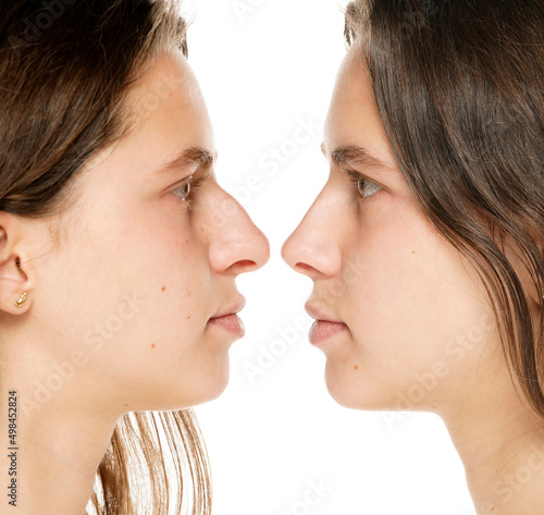 Young woman before and after plastic surgery of the nose on a white background
