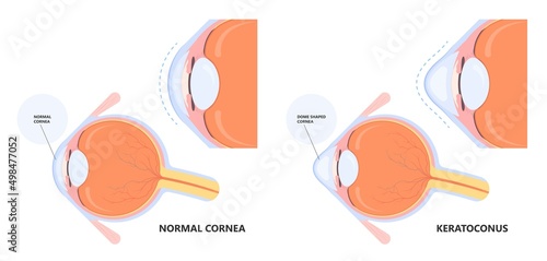 eye vision blurry retina atopy Keratoconus dry shape loss double cloudy myopia lasik glare exam vernal	