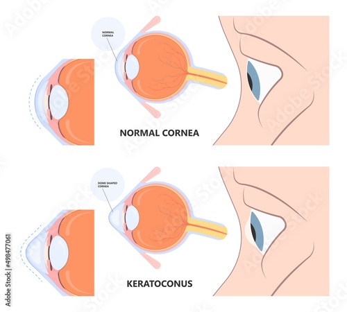 Keratoconus dry shape eye vision loss blurry double cloudy myopia lasik glare exam atopy vernal retina