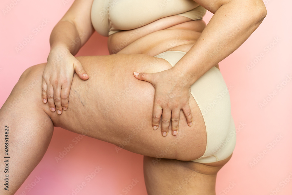 Cropped image of overweight woman sag hips, buttocks, with obesity, excess fat in lingerie. Squeezing cellulite thigh. Fast gain weight. Stomach flabs. Body after childbirth. Flabby skin need surgery