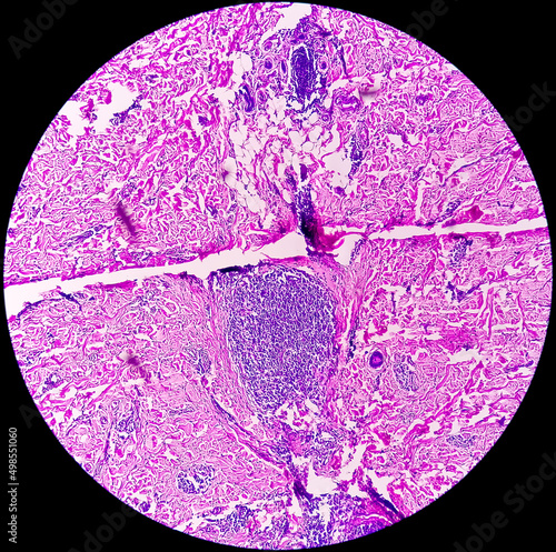 Endometrial (Uterine) cancer awareness: Photomicrograph of uterine biopsy showing Endometrial cancer or Endometrial carcinoma. photo