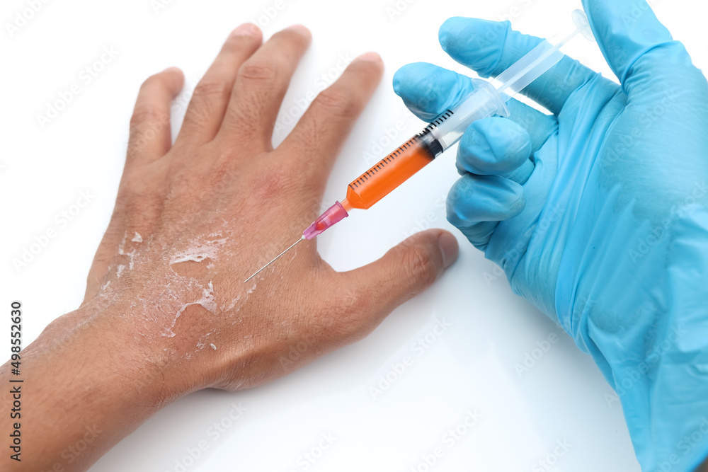 natural chemical treatment, Skin abrasions from chemical caustics natural chemical treatment, Skin abrasions from chemical caustics