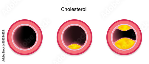 Cholesterol accumulation in blood vessels. Atherosclerosis. Clogged arteries caused by cholesterol.