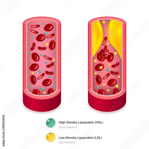 Types of cholesterol. High-Density Lipoprotein (HDL) and Low-Density Lipoprotein (LDL). Medical education.