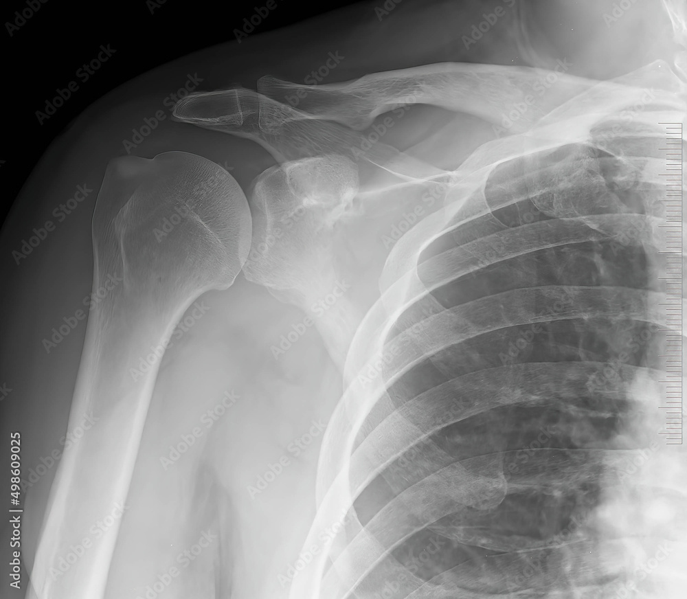 Xray shoulder joints. Acromioclavicular bones. Medical concept. Xray