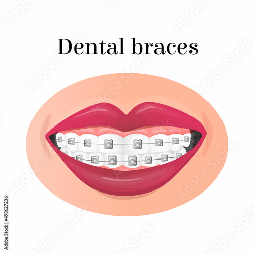 Vector isolated illustration of a smiling mouth with metal dental braces. The concept dentistry, orthodontics, alignment of teeth, a beautiful smile. It can be used in posters, flyers, web design, etc