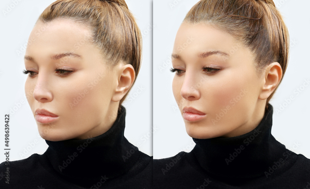 Alopecia Areata,female pattern baldness,Treatment for hair loss,Hair