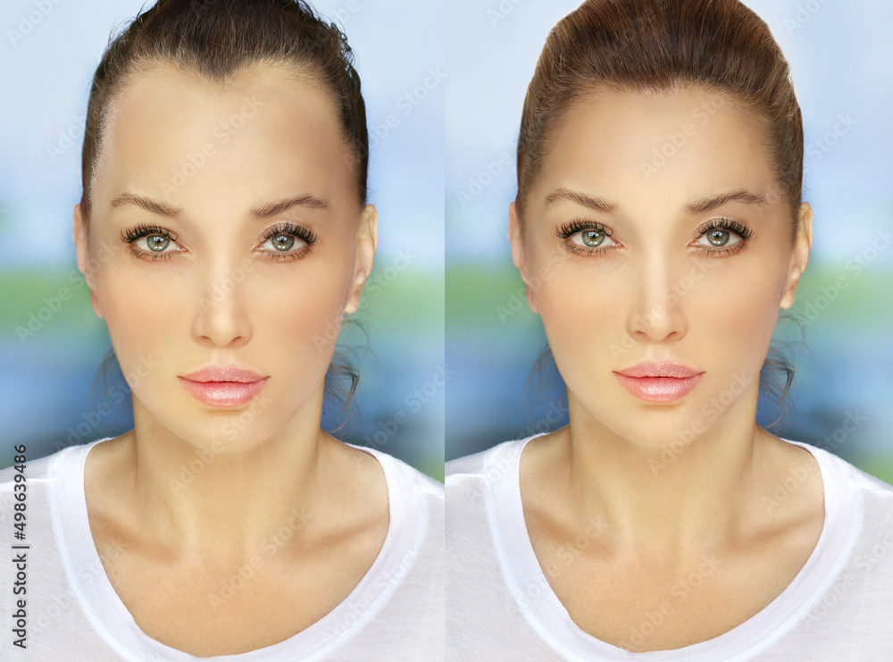 Alopecia Areata,female pattern baldness,Treatment for hair loss,Hair