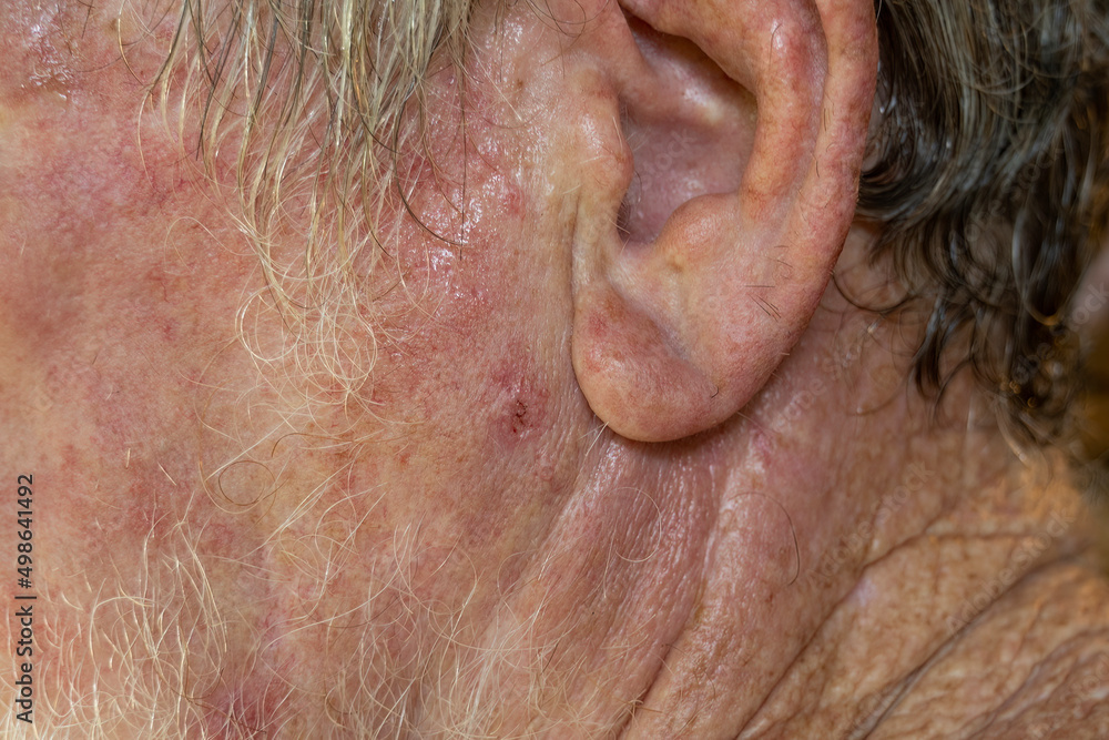 BCC basal cell carcinoma or skin cancer on the jaw of a senior caucasian male. Stock Photo