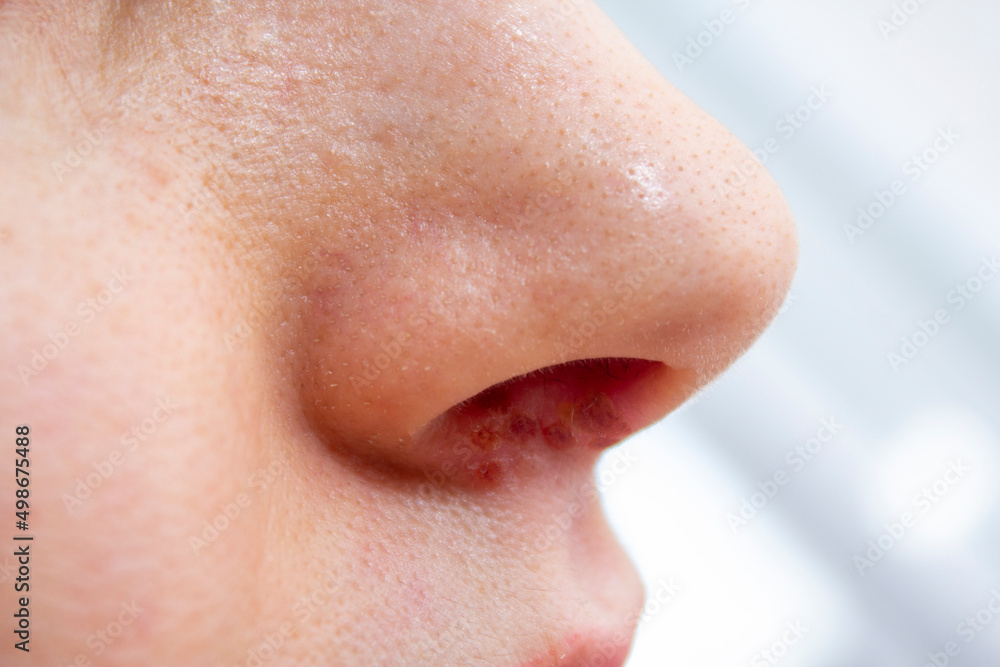 Herpes on the nose - Pretty caucasian woman with herpes her on nose, close-up. Human Virus Herpes on the nose - Pretty caucasian woman with herpes her on nose, close-up. Human Virus
