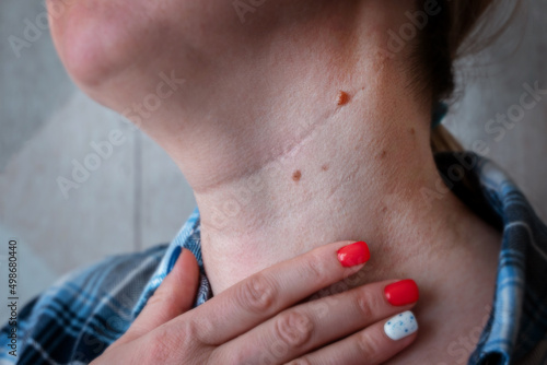 a woman shows moles on her neck