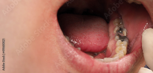 Decayed tooth root canal treatment. Tooth or teeth decay of lower molar. Restoration with a composite filling. Adult caries. bad teeth. Dental temporary restorative material. Dental concept. close up.