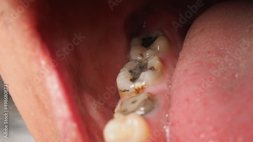 Decayed tooth root canal treatment. Tooth or teeth decay of lower molar. Restoration with a composite filling. Adult caries. bad teeth. Dental temporary restorative material. Dental concept. close up. photo