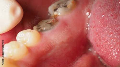 Billede på lærred Decayed tooth root canal treatment